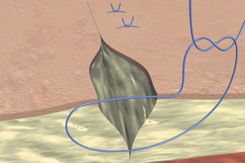 Allgöwer suture