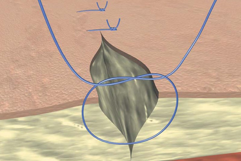Simple skin suture