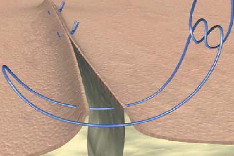 Mattress suture