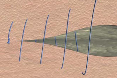 Continuous skin suture