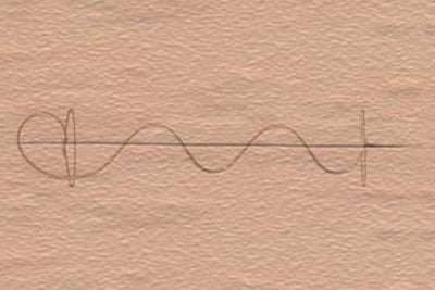 Continuous intracutaneous absorbable suture