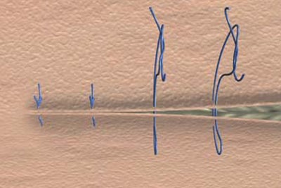Mattress suture