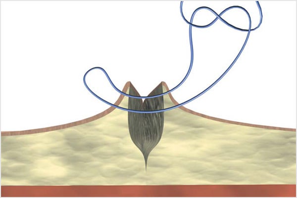 Mattress suture