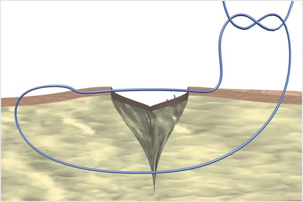 Donati suture