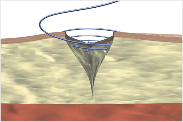 Continuous skin suture