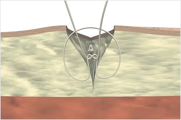 Simple subcutaneous suture