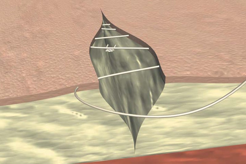 Continuous intracutaneous absorbable suture