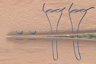 Mattress suture