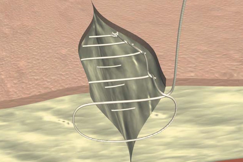 Continuous subcutaneous interlaced suture