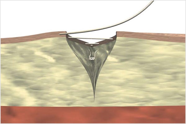 Continuous intracutaneous absorbable suture