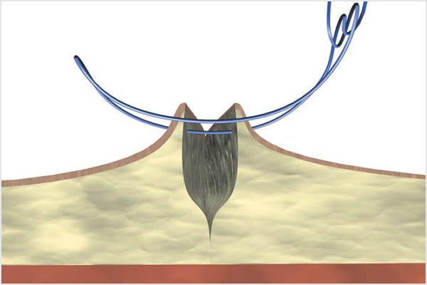 Mattress suture