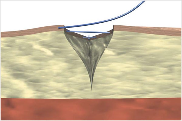 Continuous intracutaneous non-absorbable suture