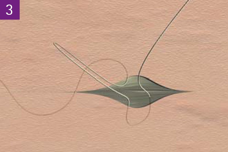 Continuous intracutaneous absorbable suture