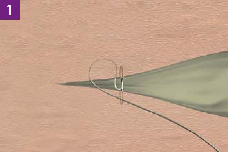 Continuous intracutaneous absorbable suture