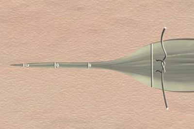 Simple subcutaneous suture