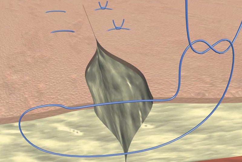 Donati suture
