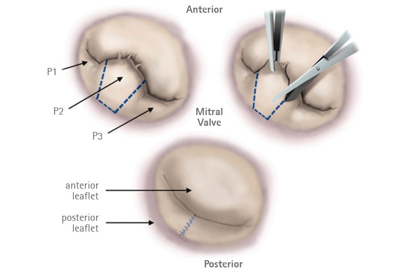Mitral Posterior leaflet quadrangular resection