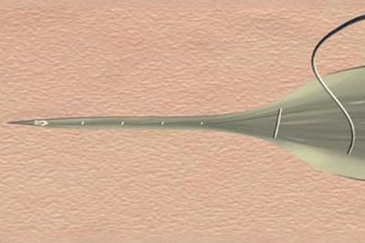Continuous subcutaneous suture
