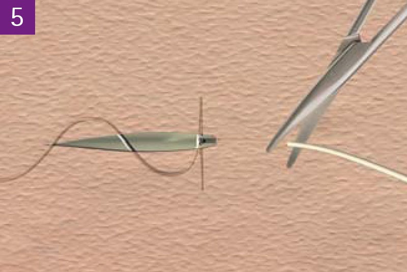 Continuous intracutaneous absorbable suture
