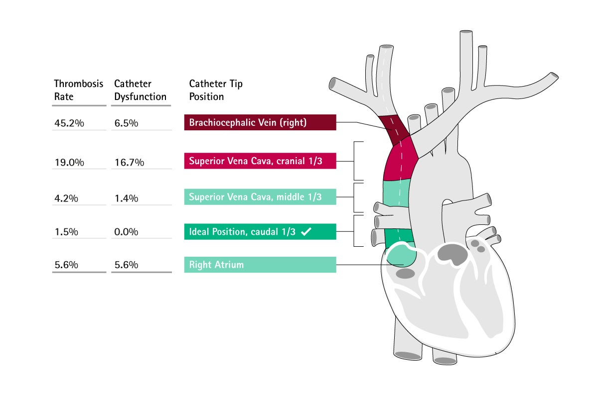 Catheter Misplacement