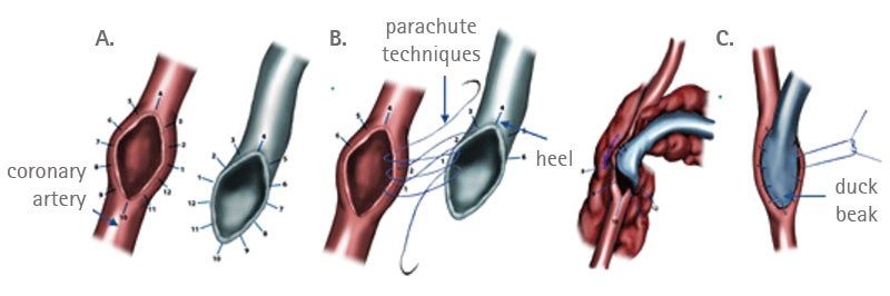 Distal anastomosis technique