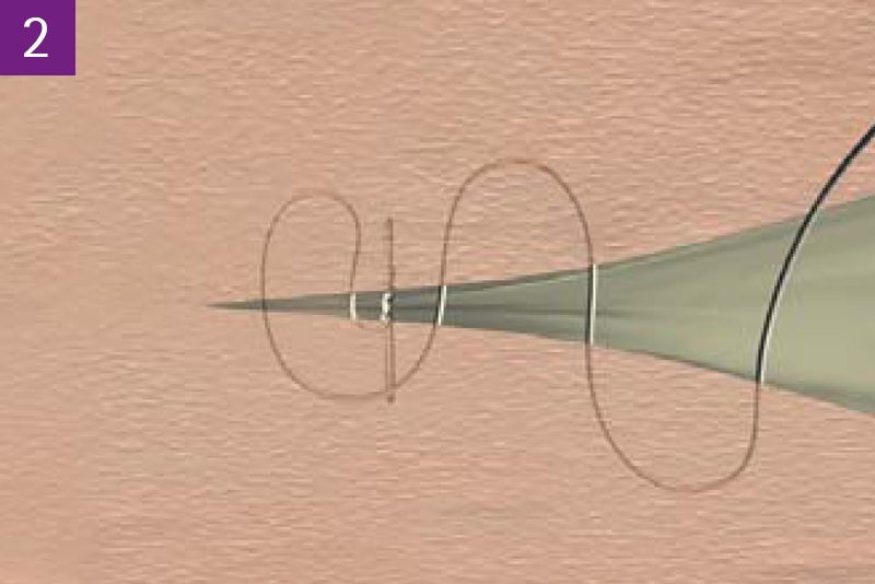 Continuous intracutaneous absorbable suture