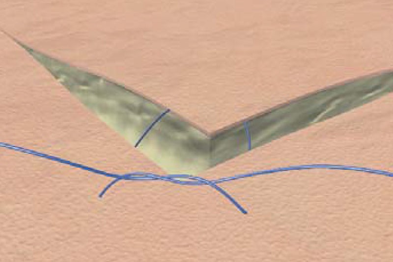 Corner suture