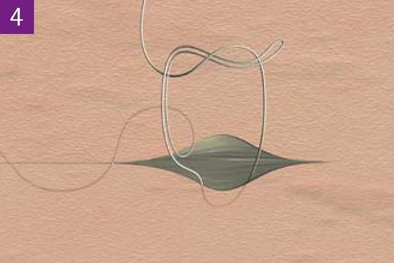 Continuous intracutaneous absorbable suture
