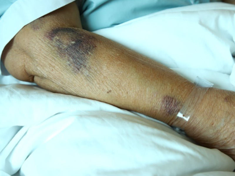 upper arm hematoma