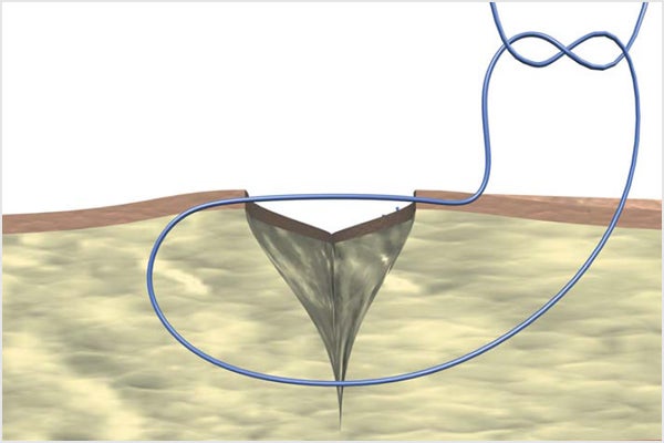 Allgöwer suture