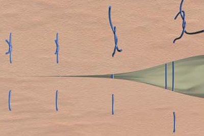 Donati suture