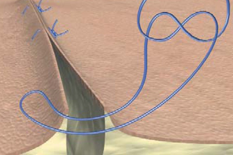 Mattress suture
