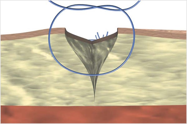 Simple skin suture