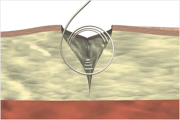 Continuous subcutaneous suture
