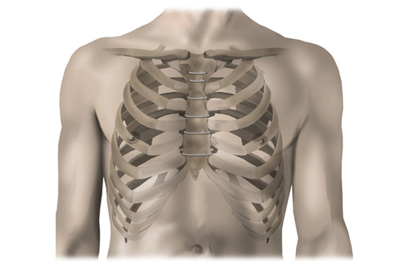 Sternal Closure