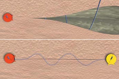 Continuous intracutaneous non-absorbable suture