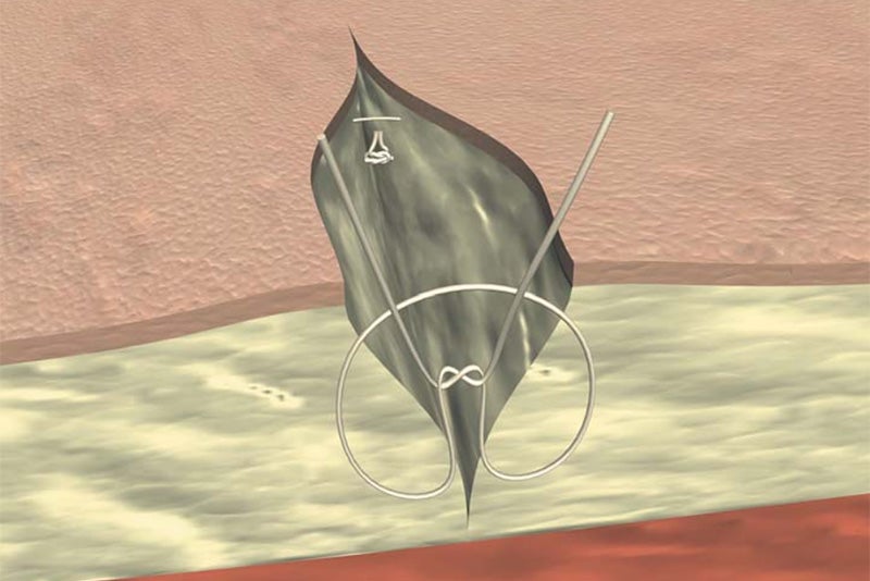 Simple subcutaneous suture