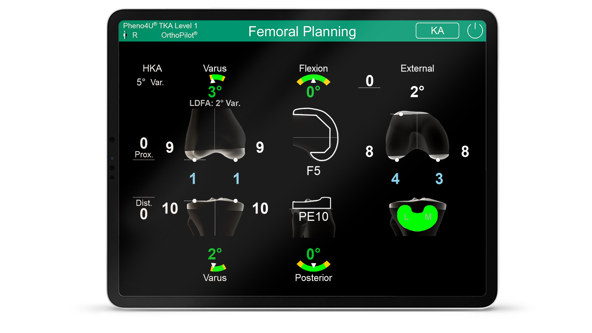 Screen of the OrthoPilot Elite navigation software Pheno4U TKA Level 1